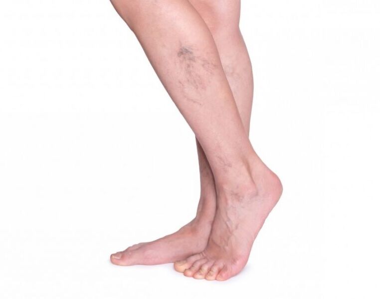 Varicose veins before treatment