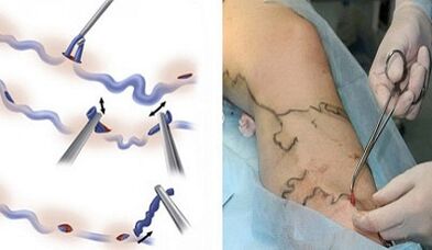 Leg vein vein removal