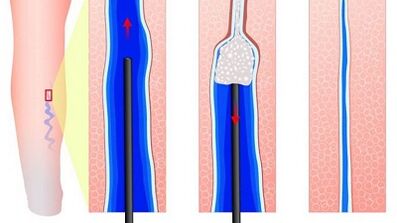 Sclerotherapy for varicose veins