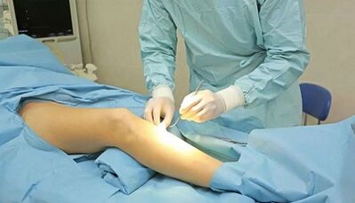 How to use varicose veins