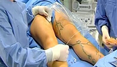 Varicocele operation