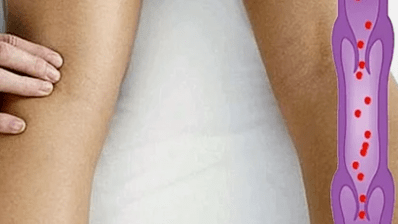 Causes of varicose veins in the lower limbs