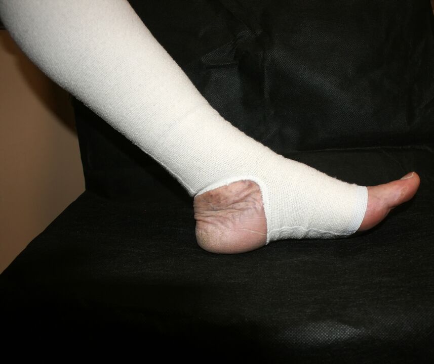 Compressed knitted suits for varicose veins