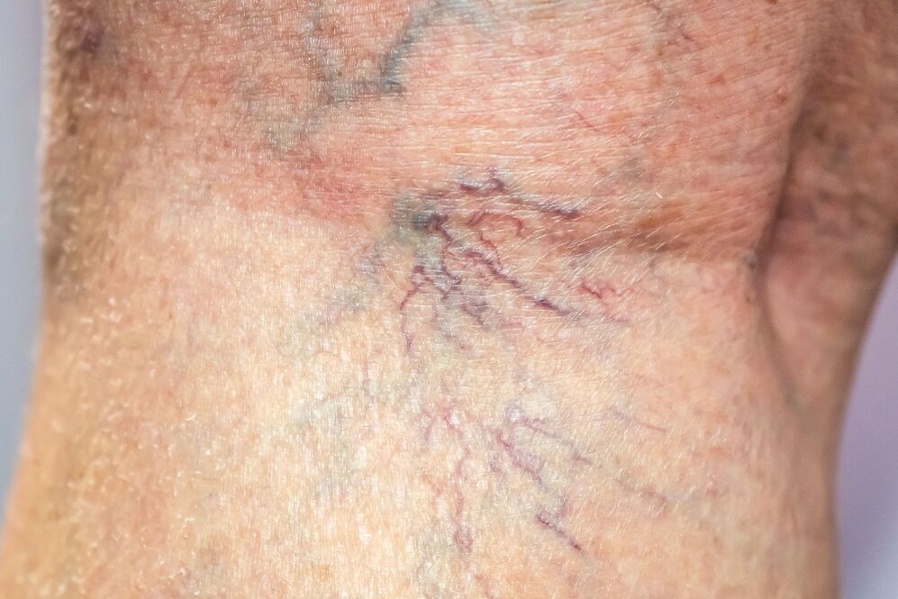 Varicose veins