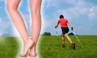 Walking type varicose veins